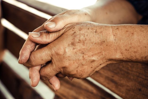 Hands with liver spots