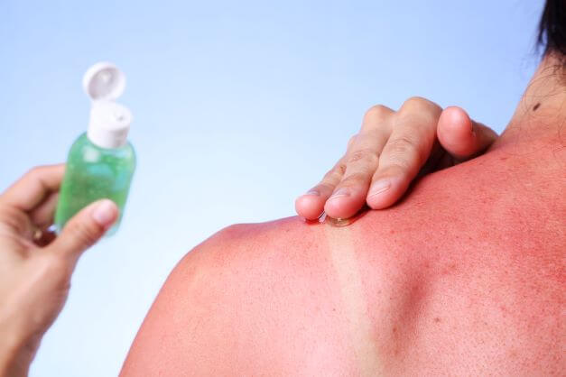 sunburn relief treatment on shoulder