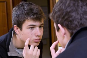 teen boy with acne