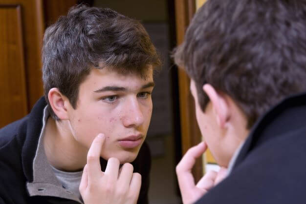 teen boy with acne