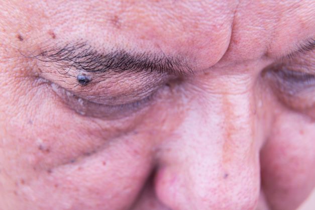 skin cancer on the eyelid