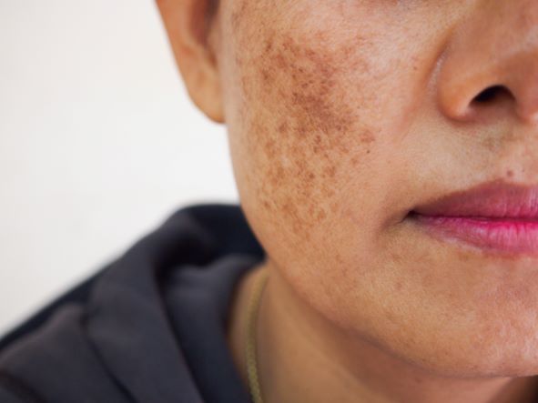 hyperpigmentation on cheek