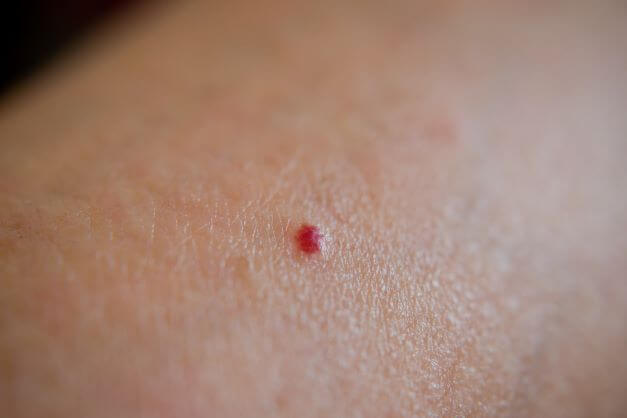 close up of cherry angioma