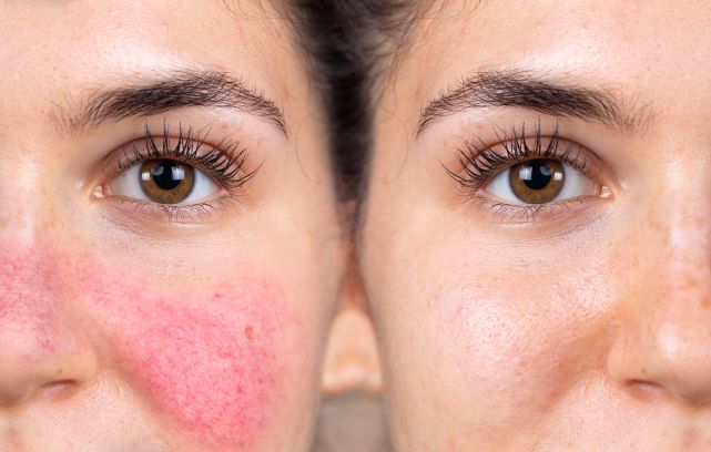 Results of laser treatment for rosacea