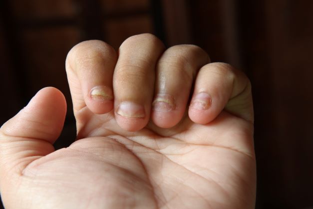 man's hand showing nail psoriasis