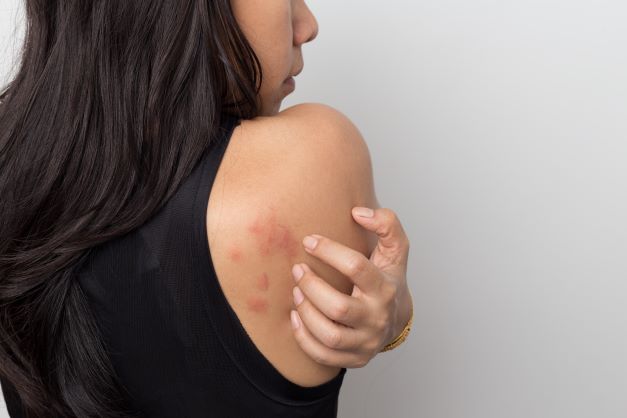 skin rash on shoulder