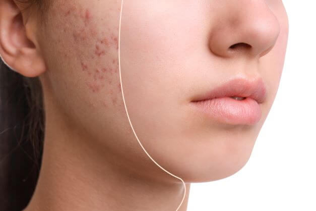 Skincare Facts 3 Things You Should Know Before You Take Accutane