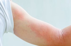 What causes hives on arm of patient