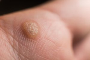 close up view of a wart on a hand