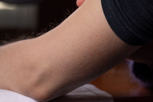 Close up of arm with keratosis pilaris