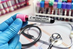 What is Monkeypox - lab technician looks at blood sample