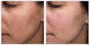 MOXI Laser Treatments