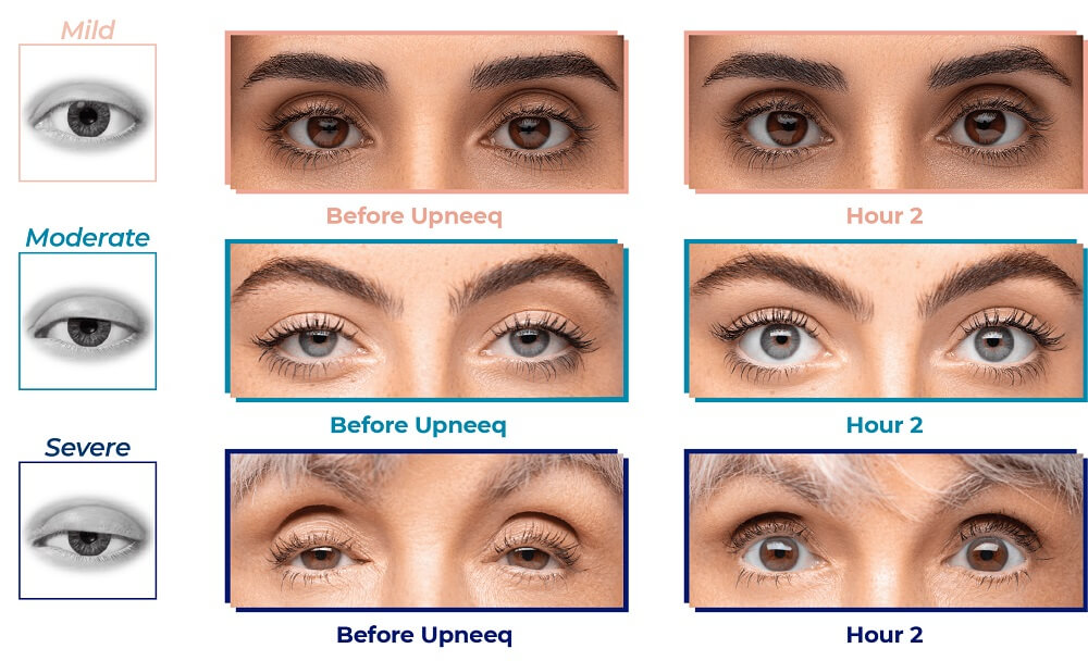 With daily use, Upneeq eye drops lift the upper eyelid, giving patients a more lifted, smooth, and youthful look.