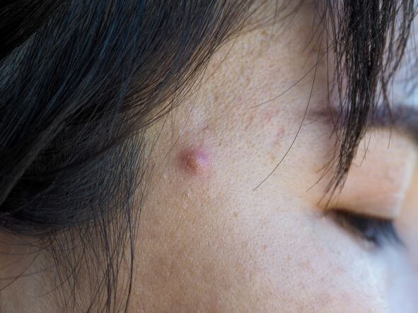 Close up view of under the skin pimples - how to get rid of under the skin pimples