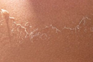 close up of skin peeling