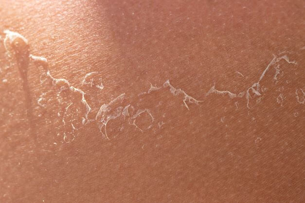 close up of skin peeling