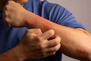 health digest article how to detect eczema