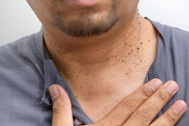 What causes skin tags? Close up image of man's neck with multiple skin tags