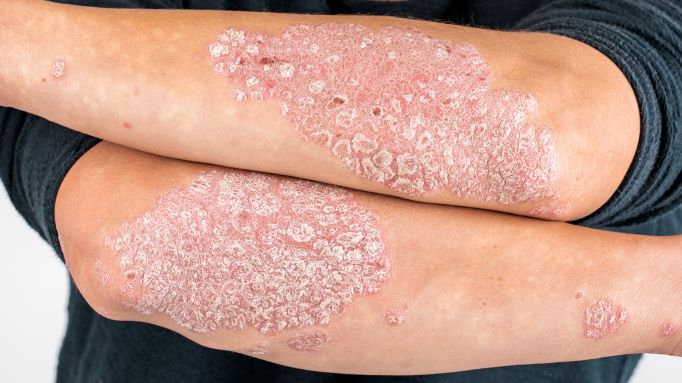 close up image of arms with plaque psoriasis