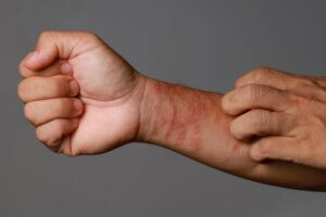 Close up image of eczema flare-up on man's arm. Man wonders how to prevent eczema flare-ups