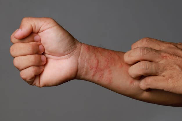 Close up image of eczema flare-up on man's arm. Man wonders how to prevent eczema flare-ups