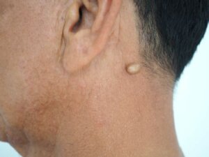 Close up image of lumps under the skin on a man's neck