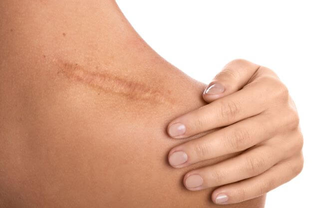 scar on woman's shoulder - scar prevention tips