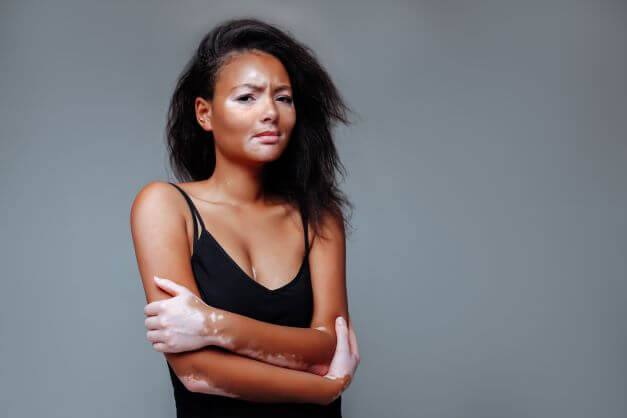 How chronic skin conditions affect mental health - woman with vitiligo suffers from mental effects of skin condition