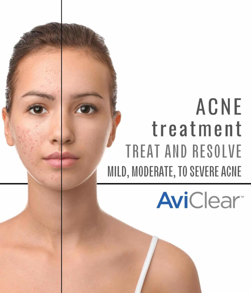 AviClear Acne Treatment is the first and original FDA-cleared energy device for the treatment of mild, moderate, and severe acne.