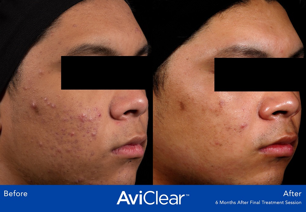 AviClear Acne Treatment is the first and original FDA-cleared energy device for the treatment of mild, moderate, and severe acne.