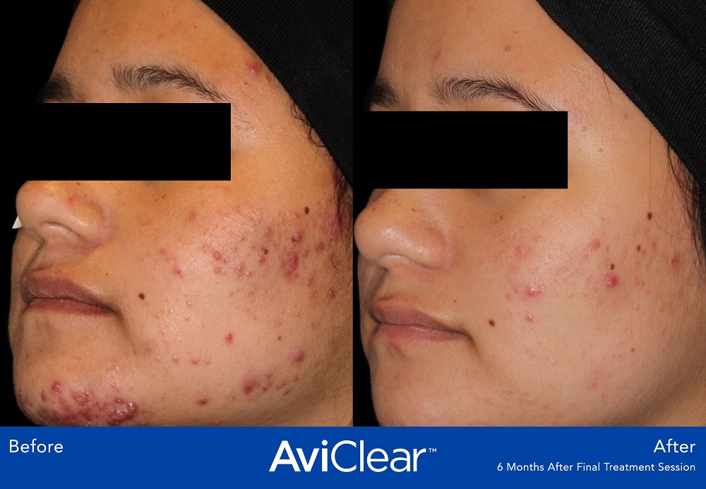 AviClear Acne Treatment is the first and original FDA-cleared energy device for the treatment of mild, moderate, and severe acne.