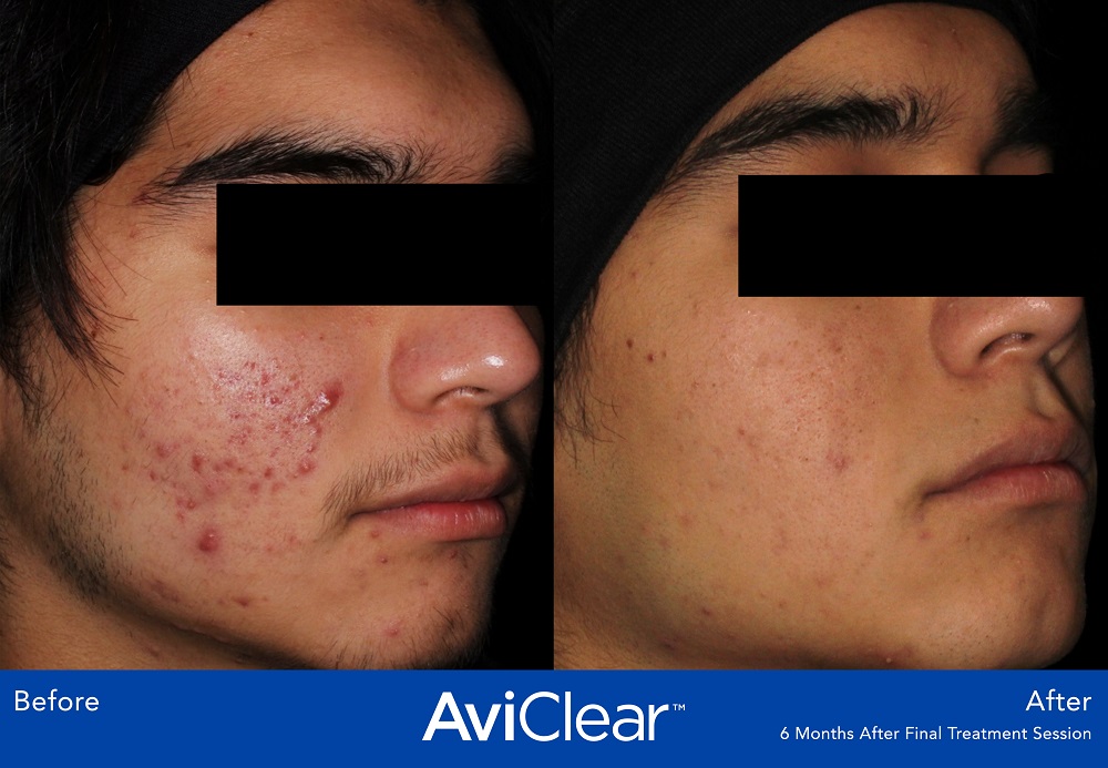 AviClear Acne Treatment is the first and original FDA-cleared energy device for the treatment of mild, moderate, and severe acne.