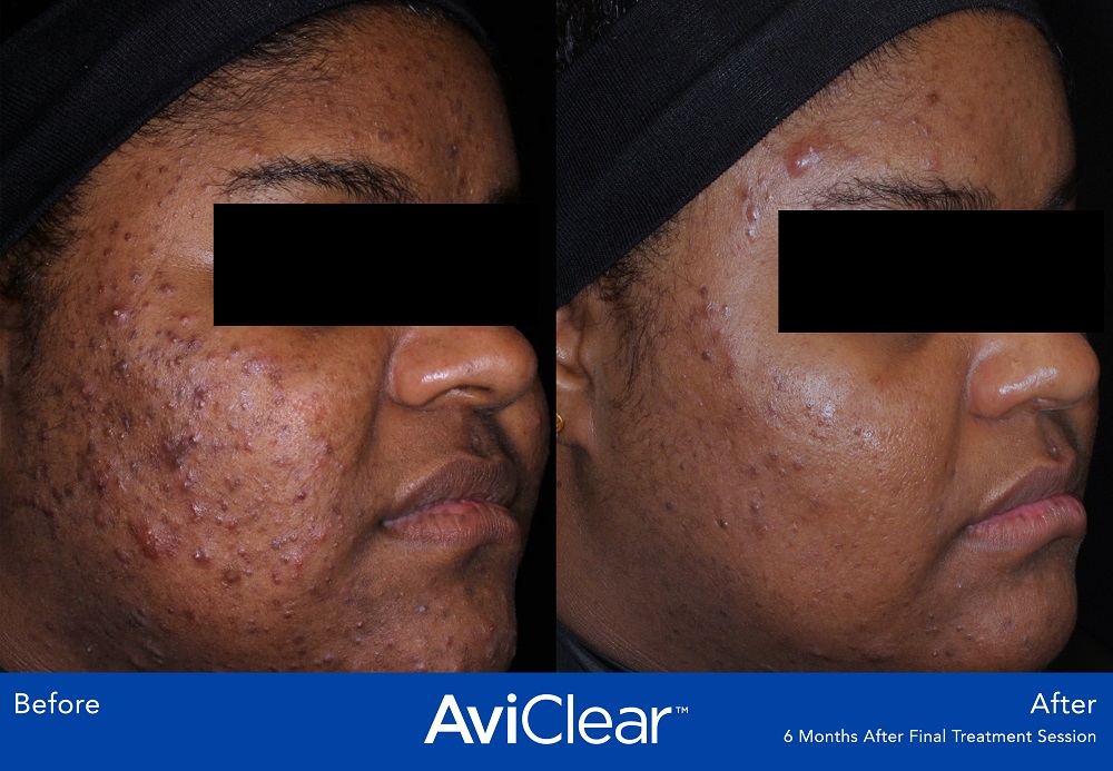 AviClear Acne Treatment is the first and original FDA-cleared energy device for the treatment of mild, moderate, and severe acne.