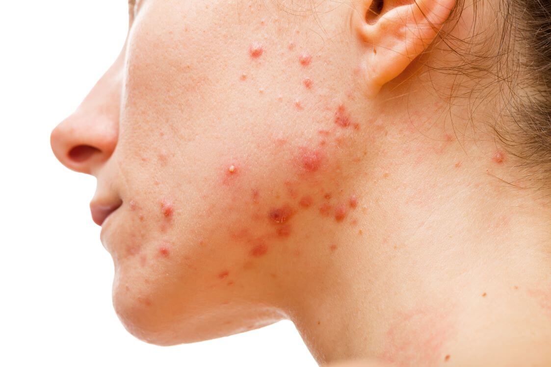 Closeup of face with different stages of acne