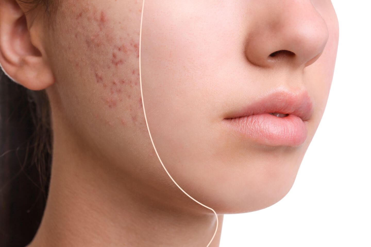 young woman who has used Accutane alternatives for treatment of acne