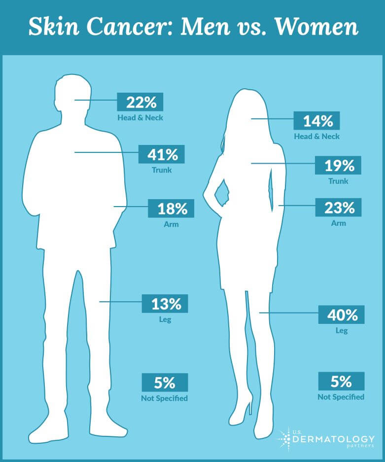 Infographic depicting the different places that men and women typically get skin cancer.