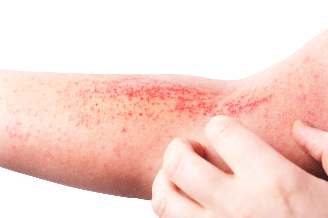 close up view of atopic dermatitis / eczema on forearm