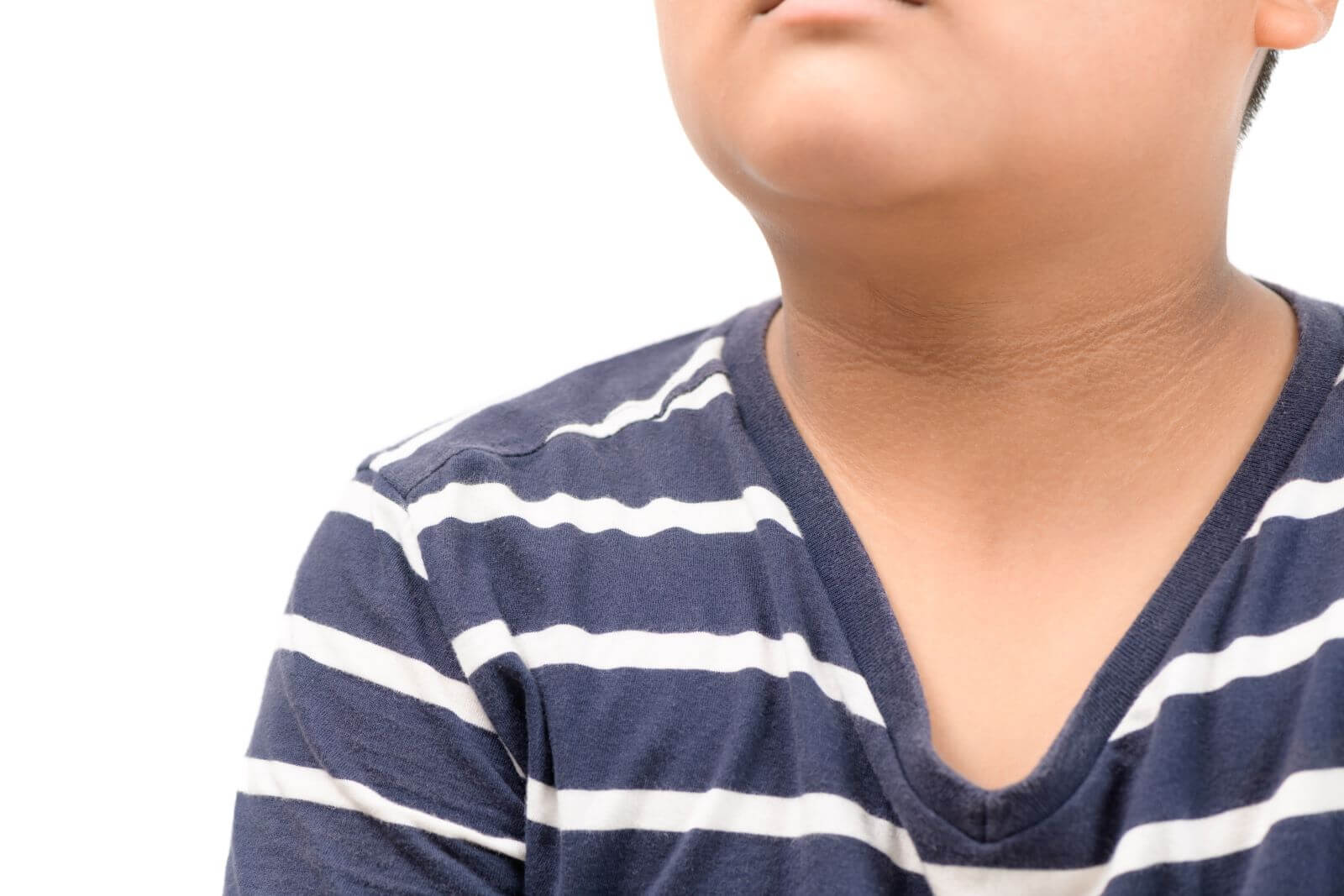 Acanthosis Nigricans on the neck of a dermatology patient