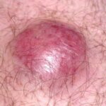 Merkel cell carcinoma is an aggressive form of skin cancer with a high mortality rate. Learn more about diagnosis and treatment options here.