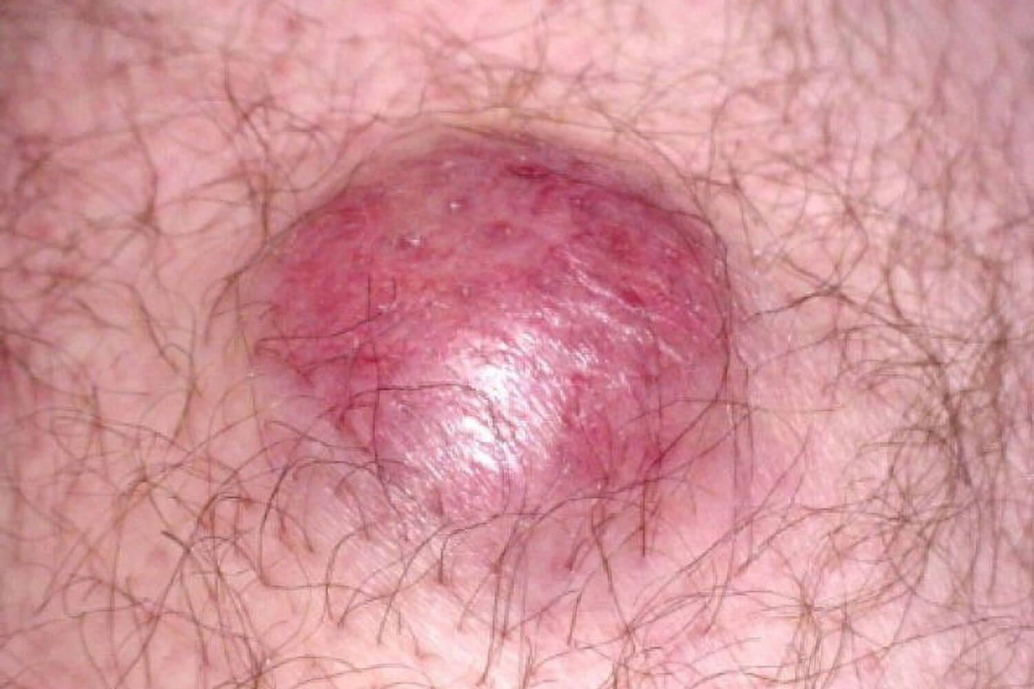 Merkel cell carcinoma is an aggressive form of skin cancer with a high mortality rate. Learn more about diagnosis and treatment options here.
