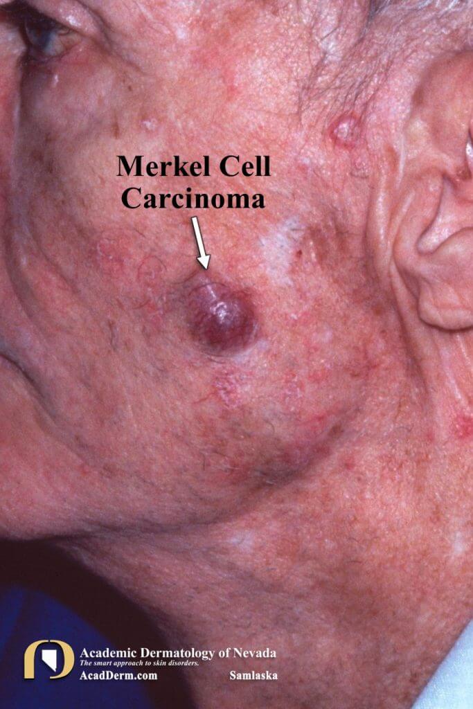 Merkel cell carcinoma is an aggressive form of skin cancer with a high mortality rate. Learn more about diagnosis and treatment options here.