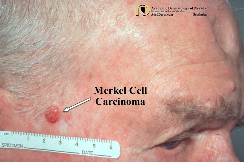 Merkel cell carcinoma is an aggressive form of skin cancer with a high mortality rate. Learn more about diagnosis and treatment options here.