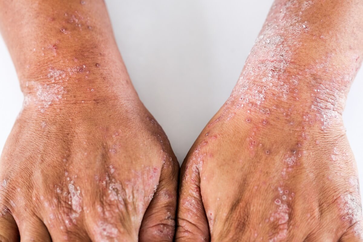 Navigating the Complexities of Atopic Dermatitis