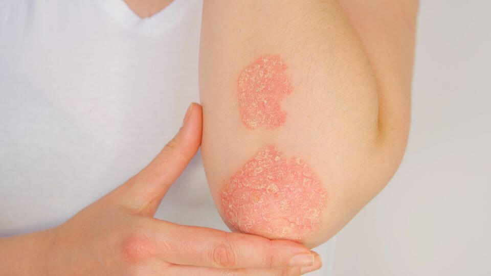 plaques on the arm of a patient with psoriasis comorbidities