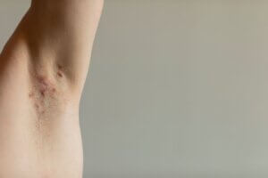 Hidradenitis Suppurativa in the armpit of a man