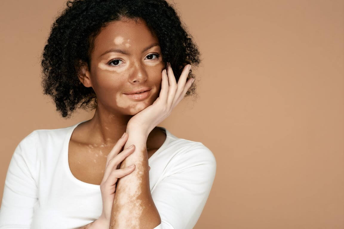 young woman with vitiligo