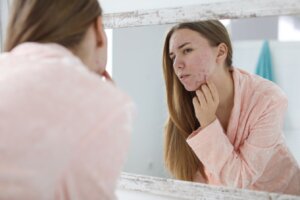 Woman with Skin PCOS symptoms, acne on chin