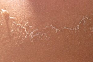 close up image of peeling skin