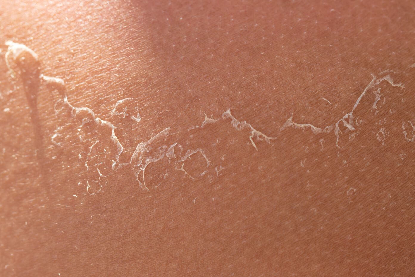 close up image of peeling skin