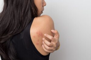 woman with rash on shoulder